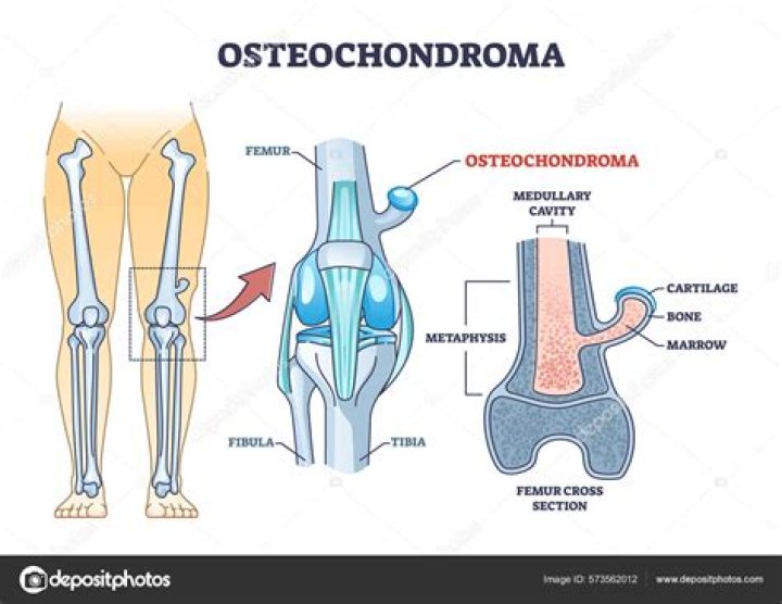 What is osteochondroma in medical?