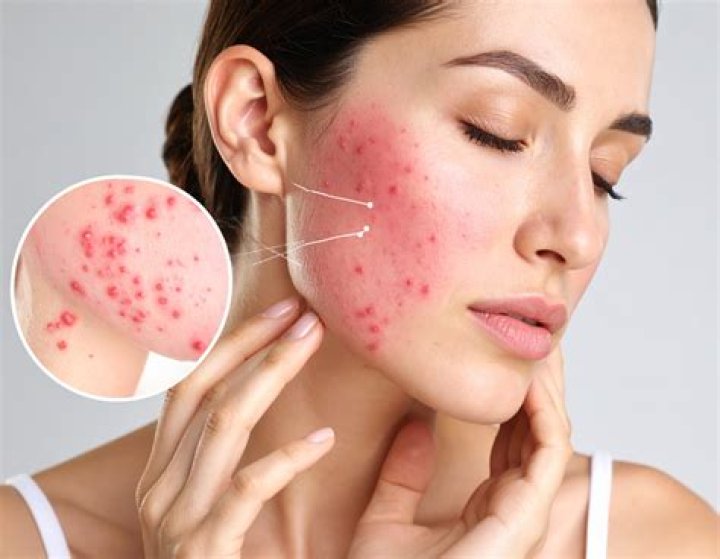 What is papulopustular acne?