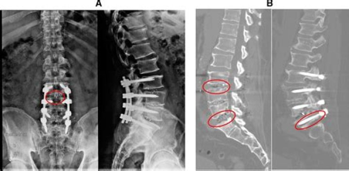 What is pseudarthrosis of lumbar spine?