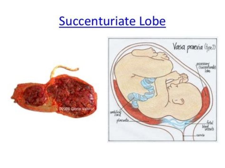 What is succenturiate lobe?