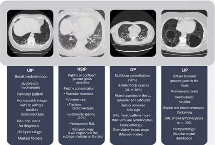 What is the difference between cryptogenic and idiopathic?