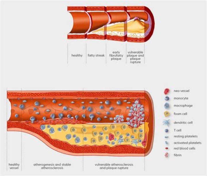 What is the main cause of atherosclerosis?