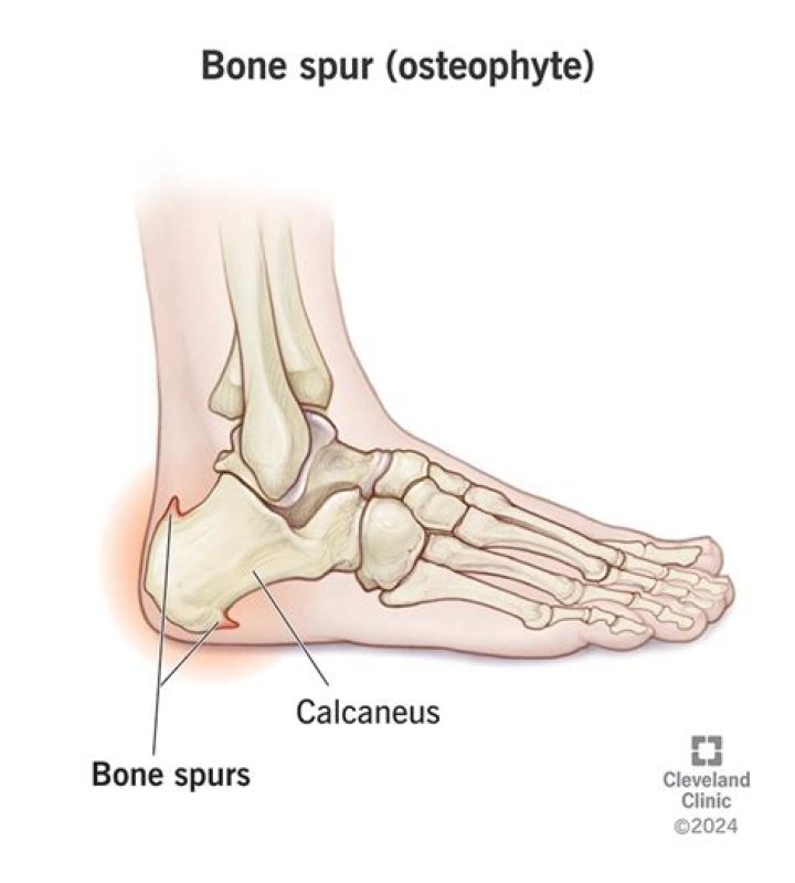 Whats a bone spur look like?