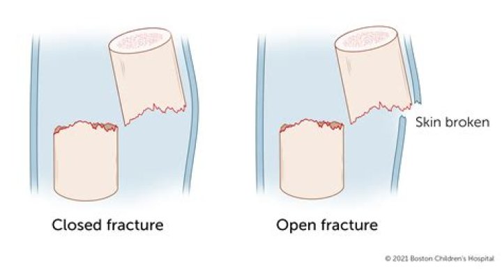 Whats a closed fracture?