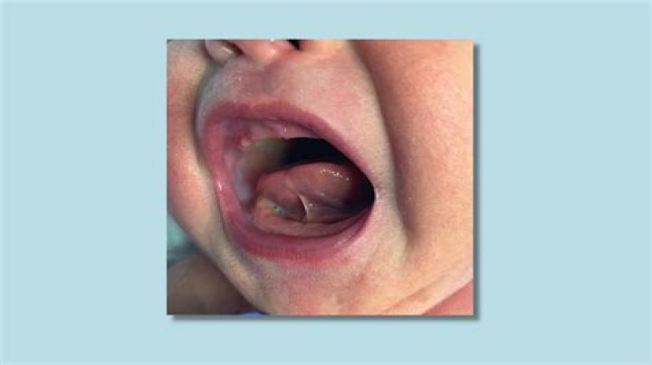 Whats a tongue tie on a baby?