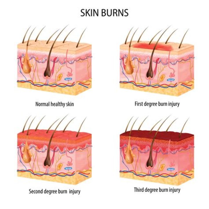 When coding multiple burns which is correct?