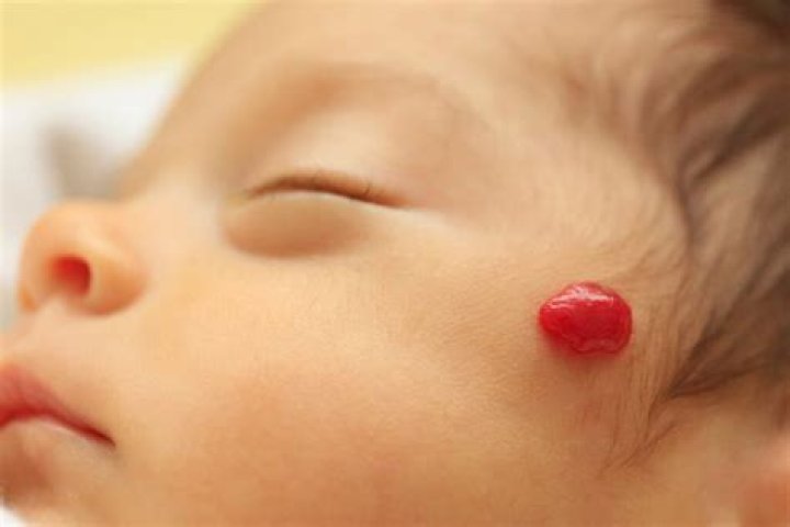 When do infantile hemangiomas stop growing?