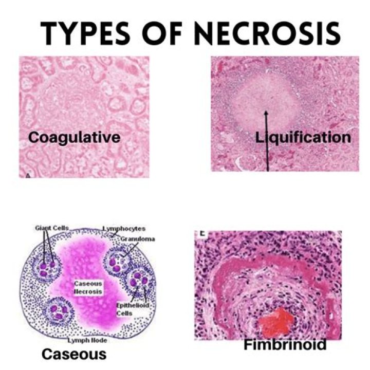 When does necrosis occur?