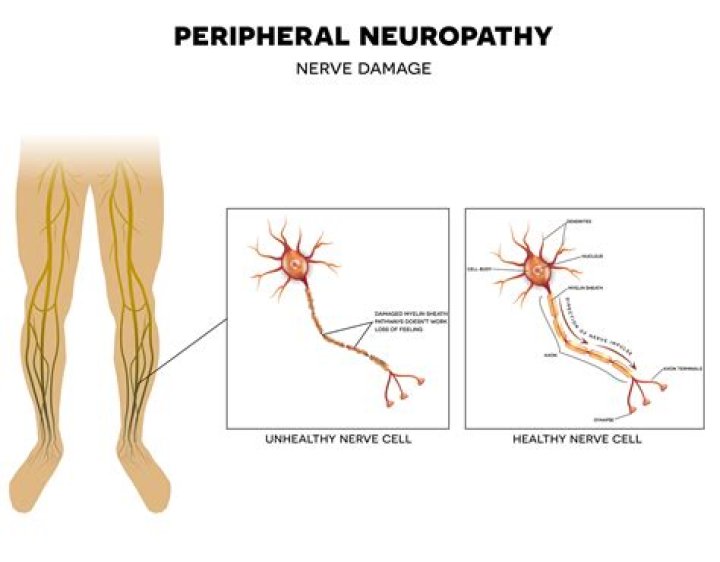 When does peripheral neuropathy go away?