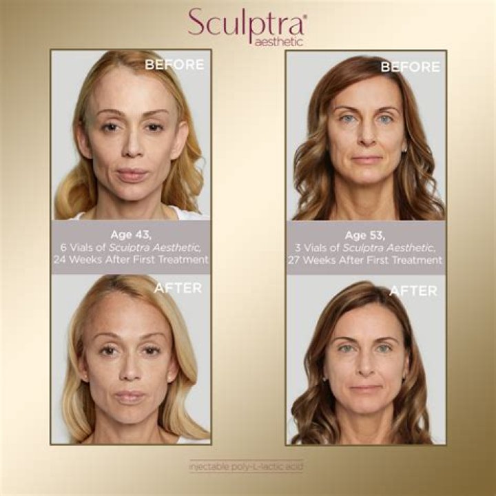 When does sculptra start working?