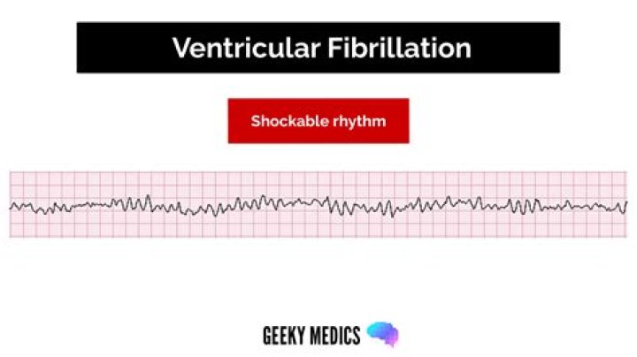 When is a heart rhythm shockable?