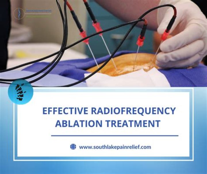 When is radiofrequency ablation used?