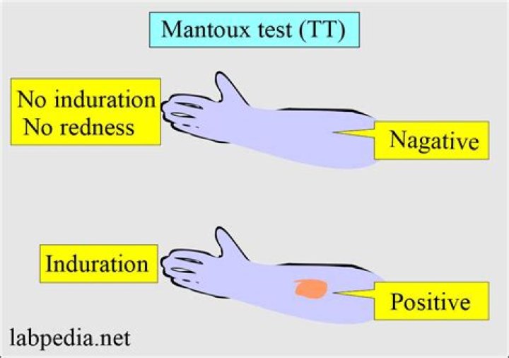 When mantoux test is positive?
