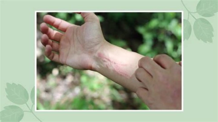 When poison ivy stops itching?