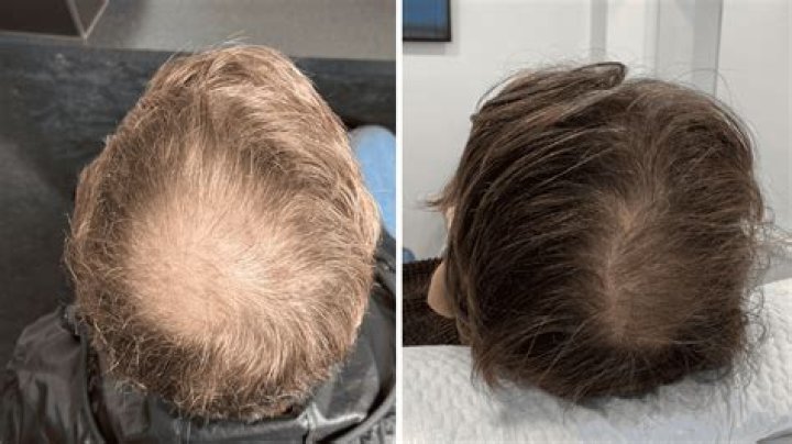 When prp after hair transplant?