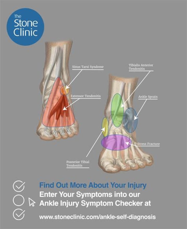 When to ice a foot injury?