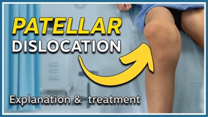 When was subluxation first used?