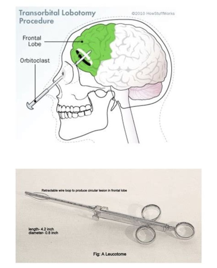 When was the last transorbital lobotomy?