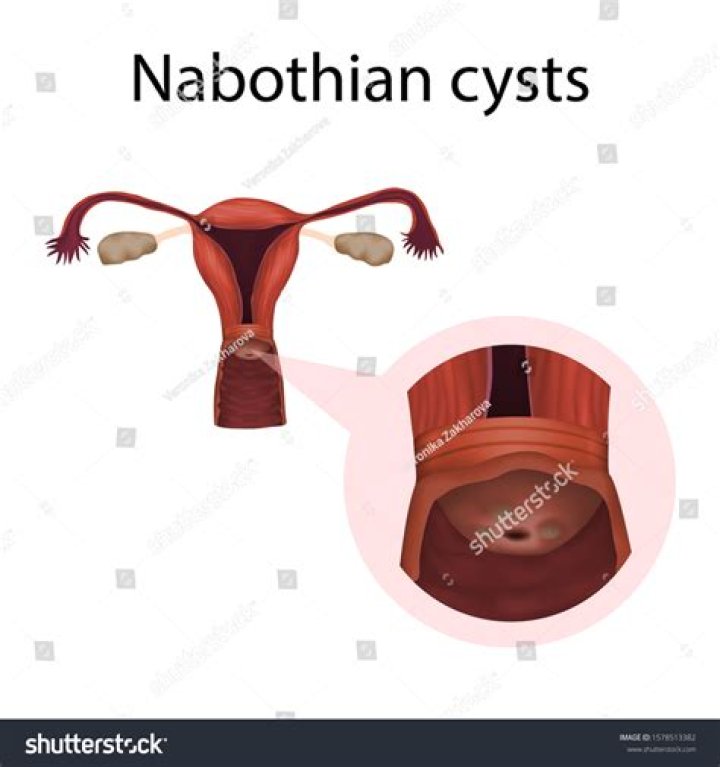 Where are nabothian cysts located?