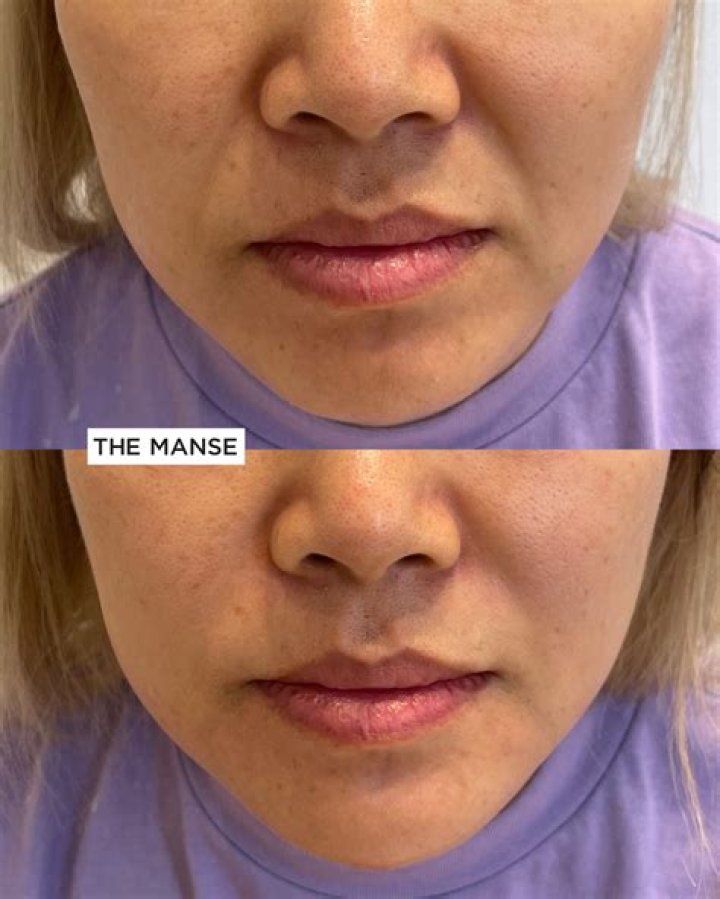 Where do you inject filler for nasolabial folds?