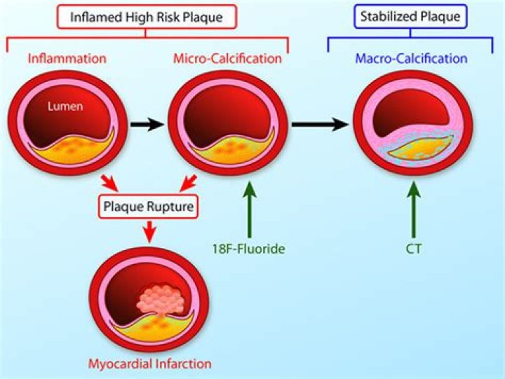 Where does calcification occur?