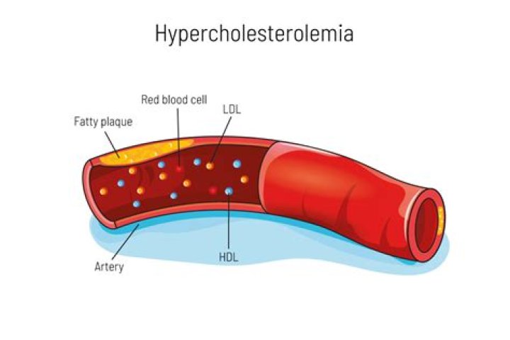Where does hypercholesterolemia occur?