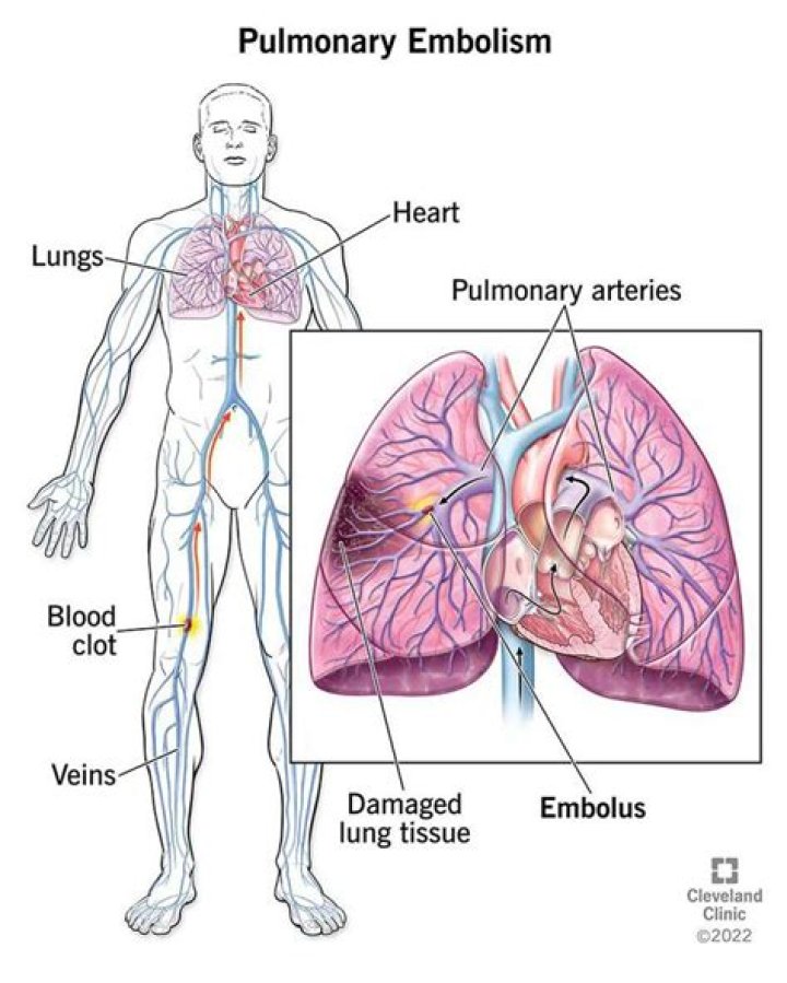 Where is arterial embolism?