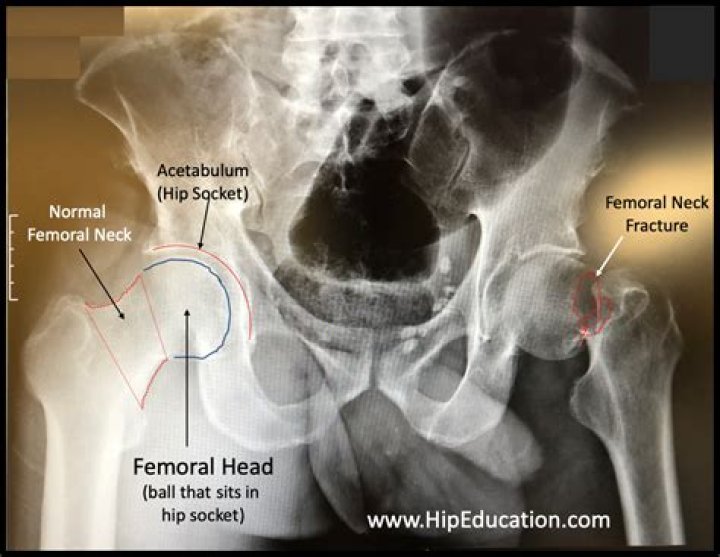 Where is the femoral neck bone?