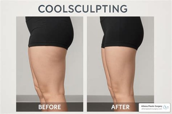 Which is better coolsculpting or heat sculpting?