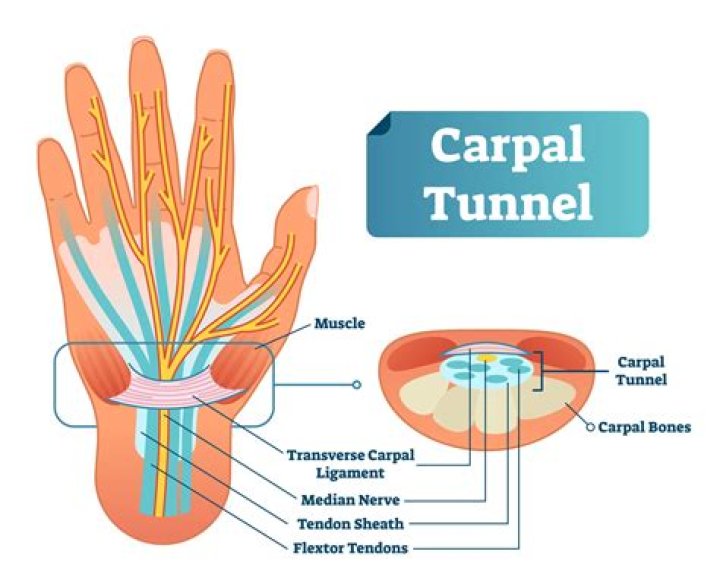 Which nerve is pinched in carpal tunnel syndrome?