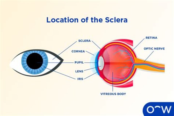 Which pathophysiology causes a scleral crescent?