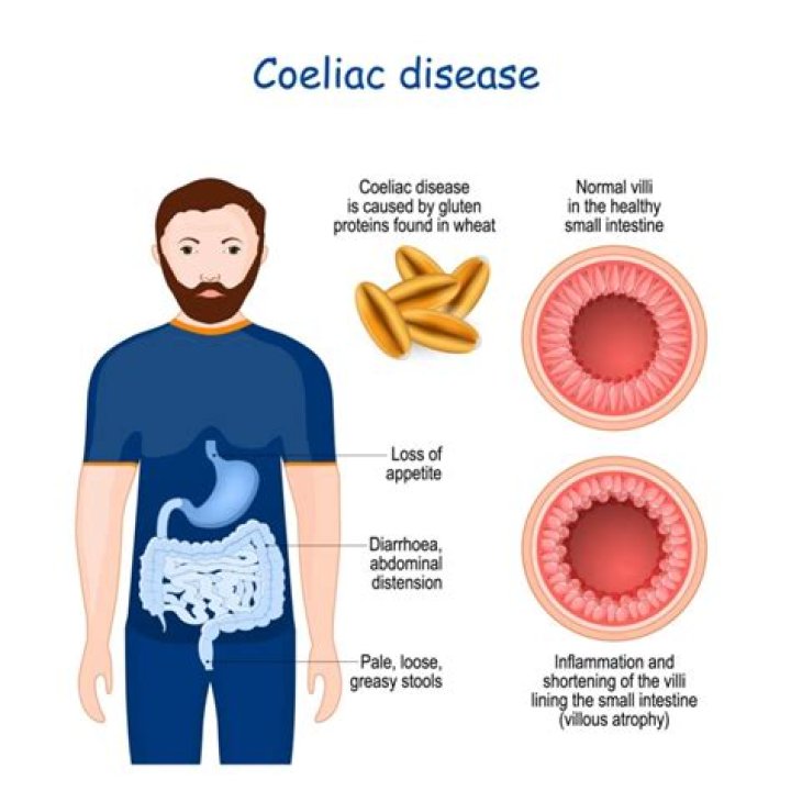 Who can get coeliac disease?