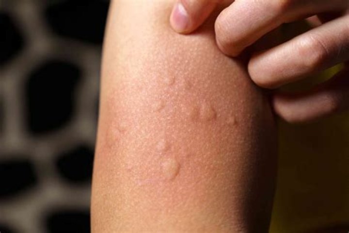 Who discovered aquagenic urticaria?