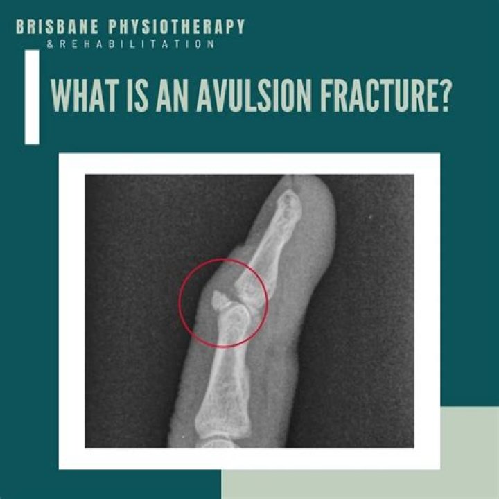 Who is avulsion fracture?