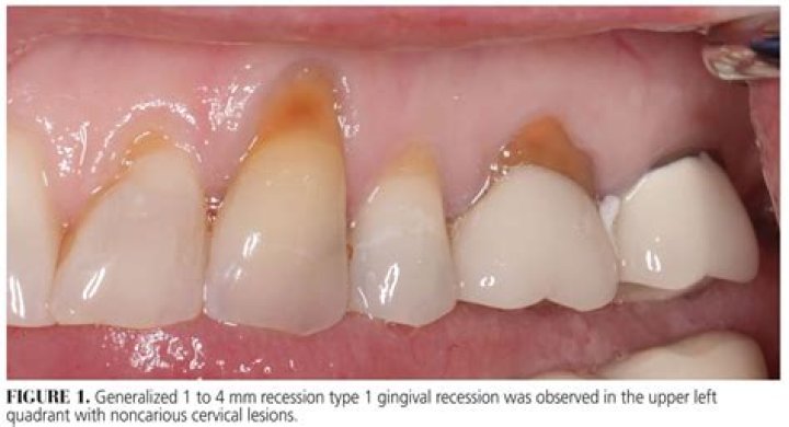 Who is gingival recession?