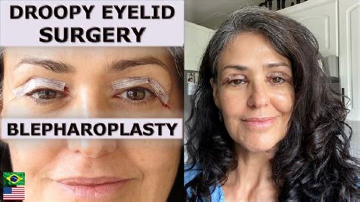 Who performs droopy eyelid surgery?