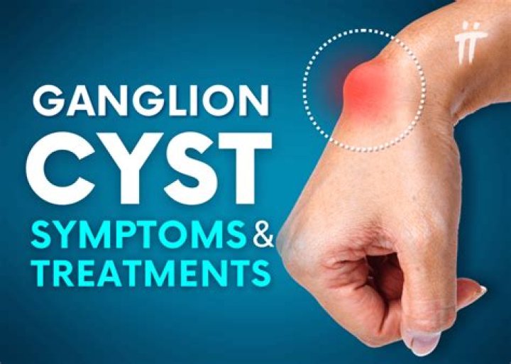Who removes a ganglion cyst from the wrist?