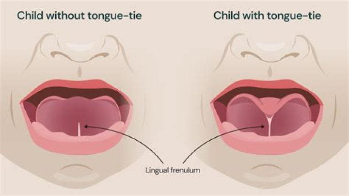 Who to see for tongue tie?
