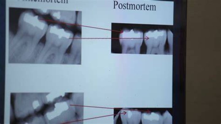Why are bodies identified by dental records?