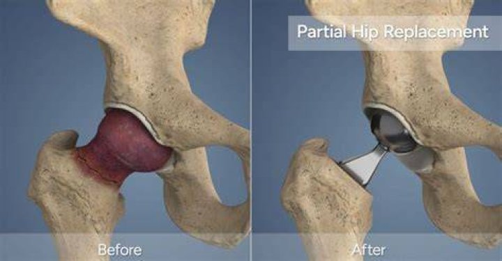 Why cemented bipolar hemiarthroplasty?