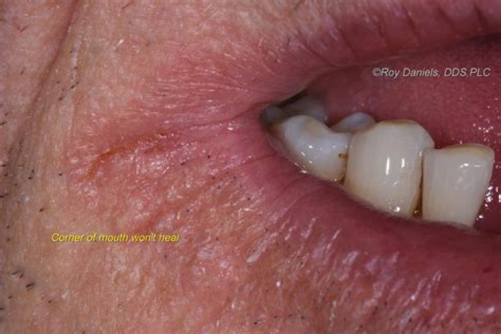 Why cuts on side of lips?