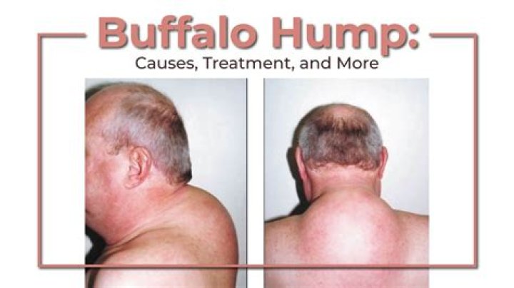 Why do buffaloes have humps?