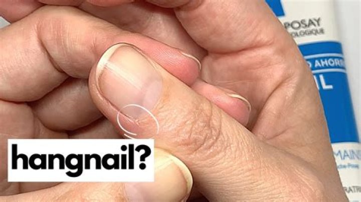 Why do hangnails form?