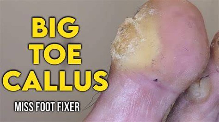 Why do i get calluses?