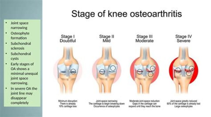 Why do osteophytes form in osteoarthritis?