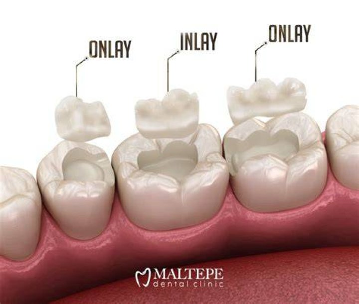 Why does inlay mean?