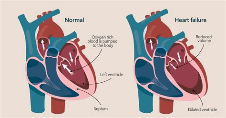 Why dyspnoea in heart failure?