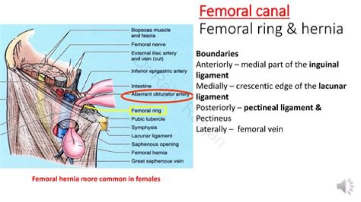 Why femoral hernia is common in females?
