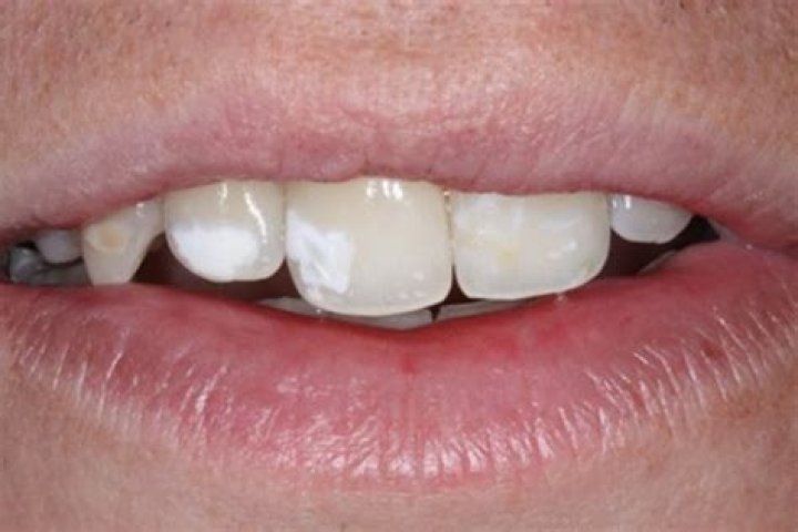 Why have i got a white spot on my tooth?