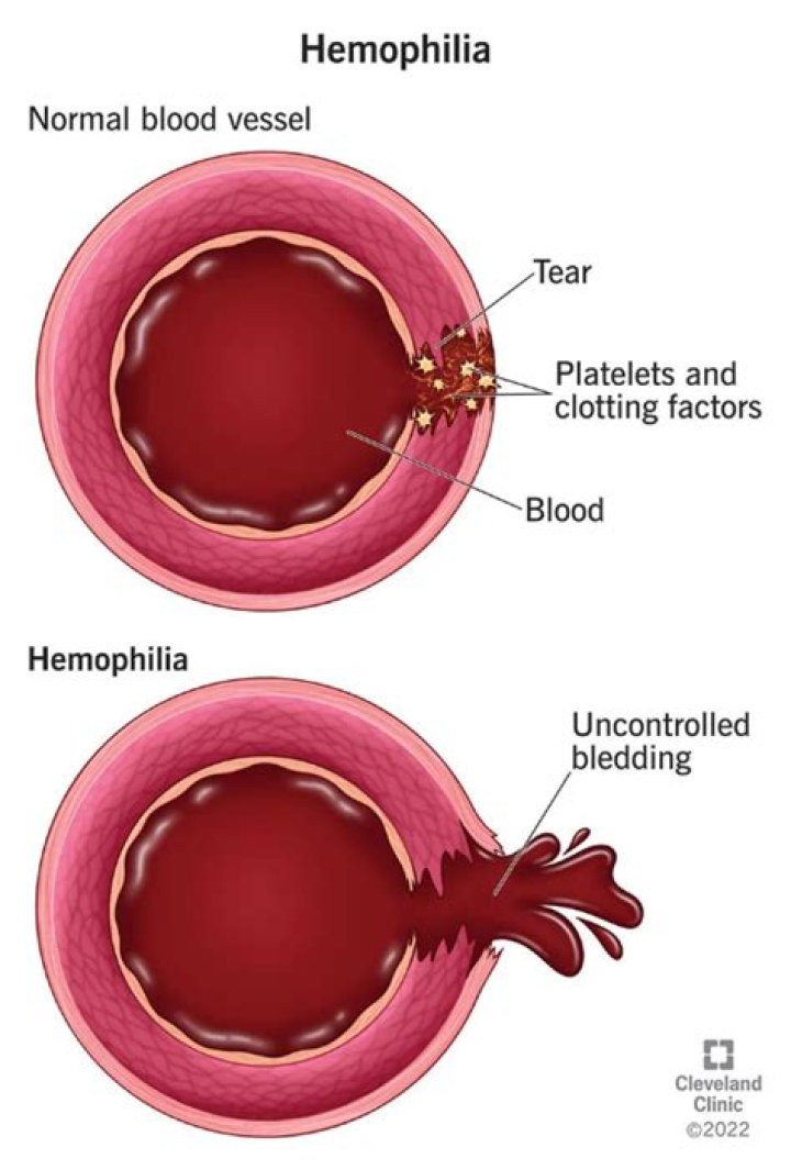 Why hemophilia is bad?